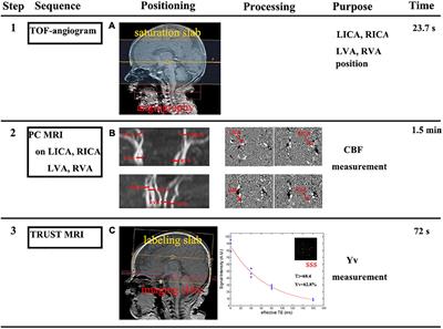 The Association Between Pregnancy-Induced Hypertension and Neonatal Cerebral Metabolism, Hemodynamics, and Brain Injury as Determined by Physiological Imaging